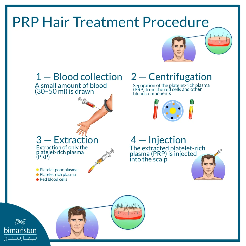 Diagram Illustrating The Main Steps Of Prp Therapy For Hair Loss, From Blood Collection To Scalp Injection.