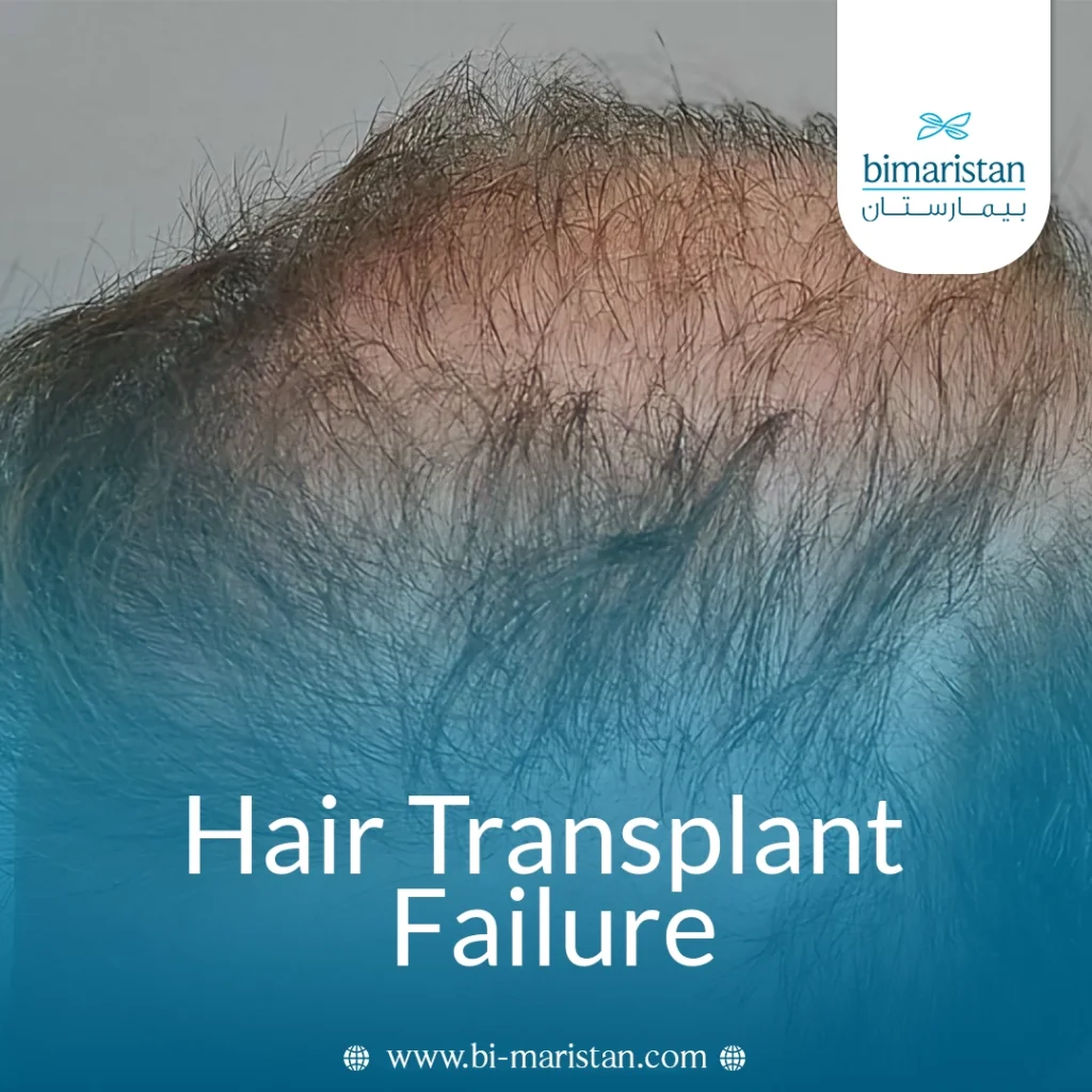 Hair Transplant Failure