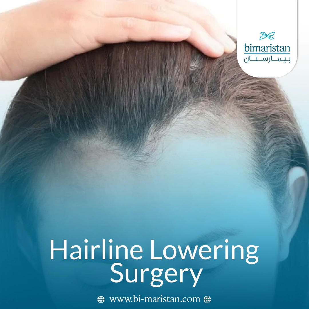 Everything You Need To Know About Hairline Lowering Surgery: Procedure Steps And Costs