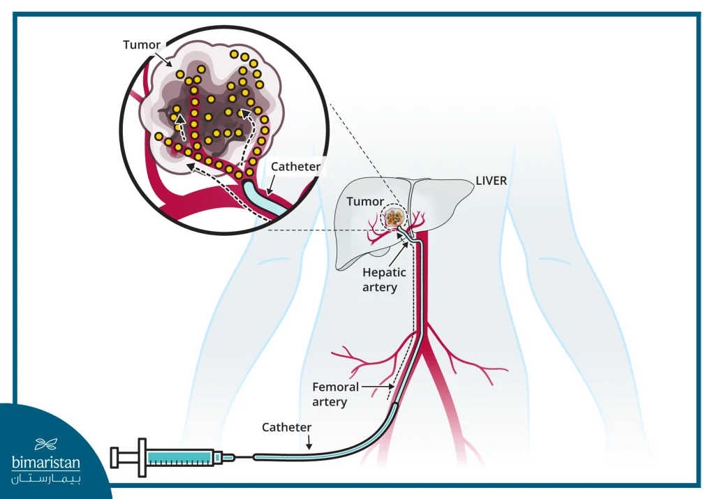 Tace Cost In Turkey 2026: Updated Chemoembolization Prices And Treatment Options 2 Illustration Showing Delivery Of Therapy To A Liver Tumor Through A Catheter Inserted Via The Femoral Artery Into The Hepatic Artery