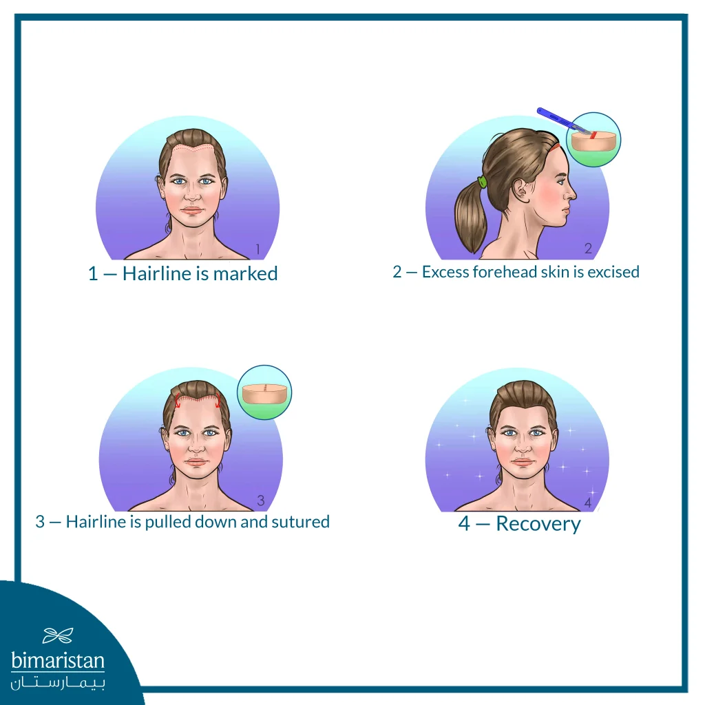 Illustration Showing The Main Steps Of A Hairline-Lowering Procedure, From Marking The Line To Excision, Repositioning, And Recovery.