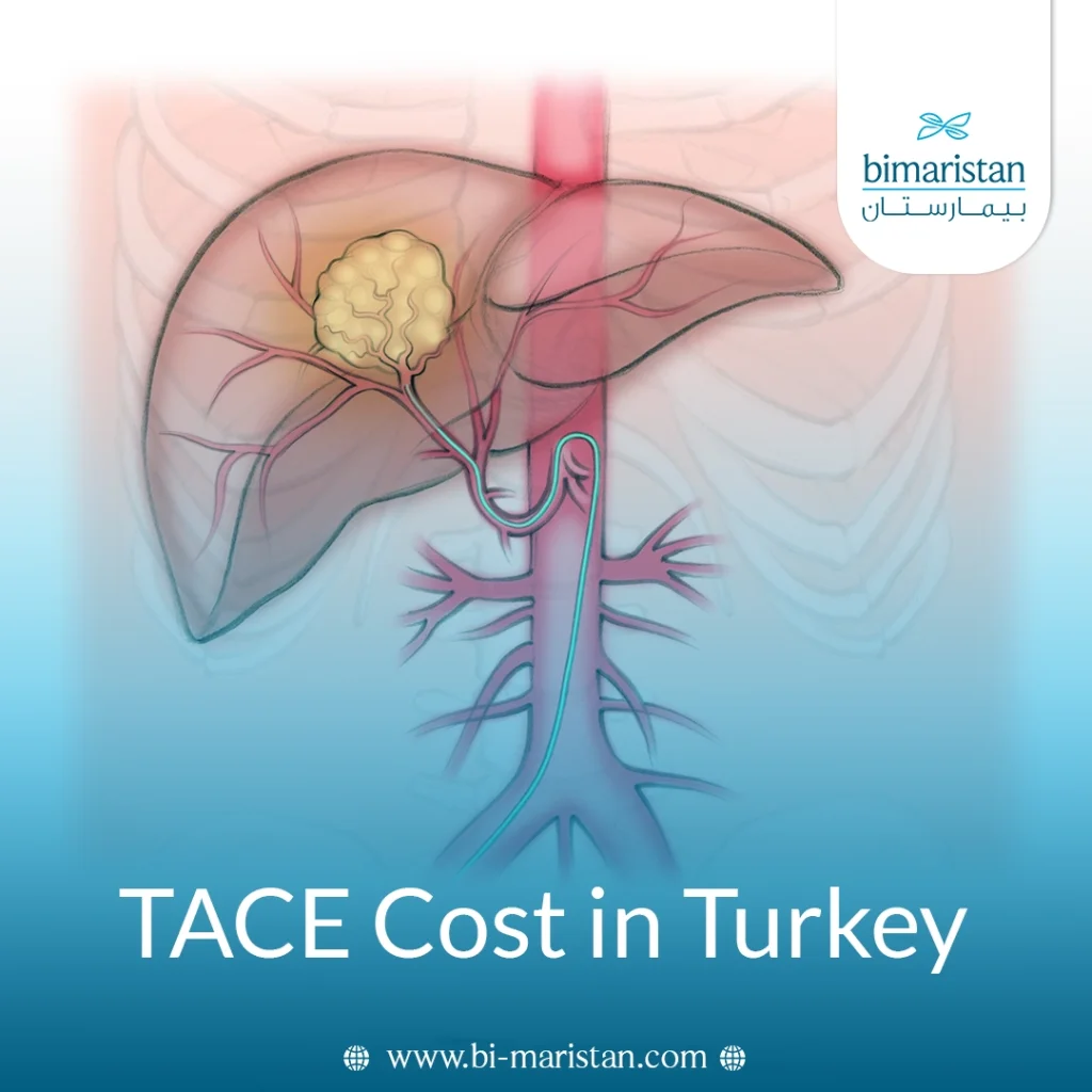 Tace Cost In Turkey 2026: Updated Chemoembolization Prices And Treatment Options 3 Tace Cost In Turkey