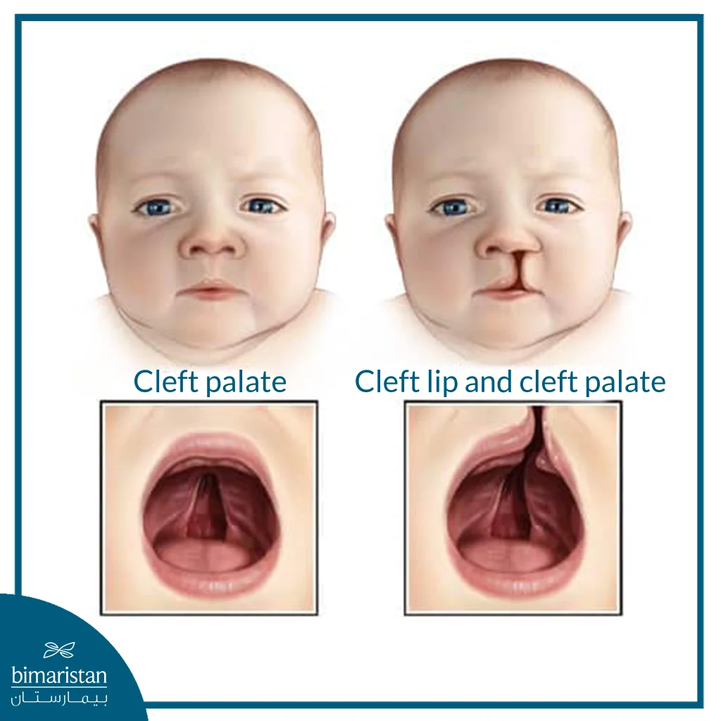 Cleft Lip And Palate Surgery Cost In Turkey 2026: Affordable Treatment, Expert Care, And Rehabilitation Options 2 The Image Shows The Difference Between An Isolated Cleft Palate And A Combined Cleft Lip And Palate
