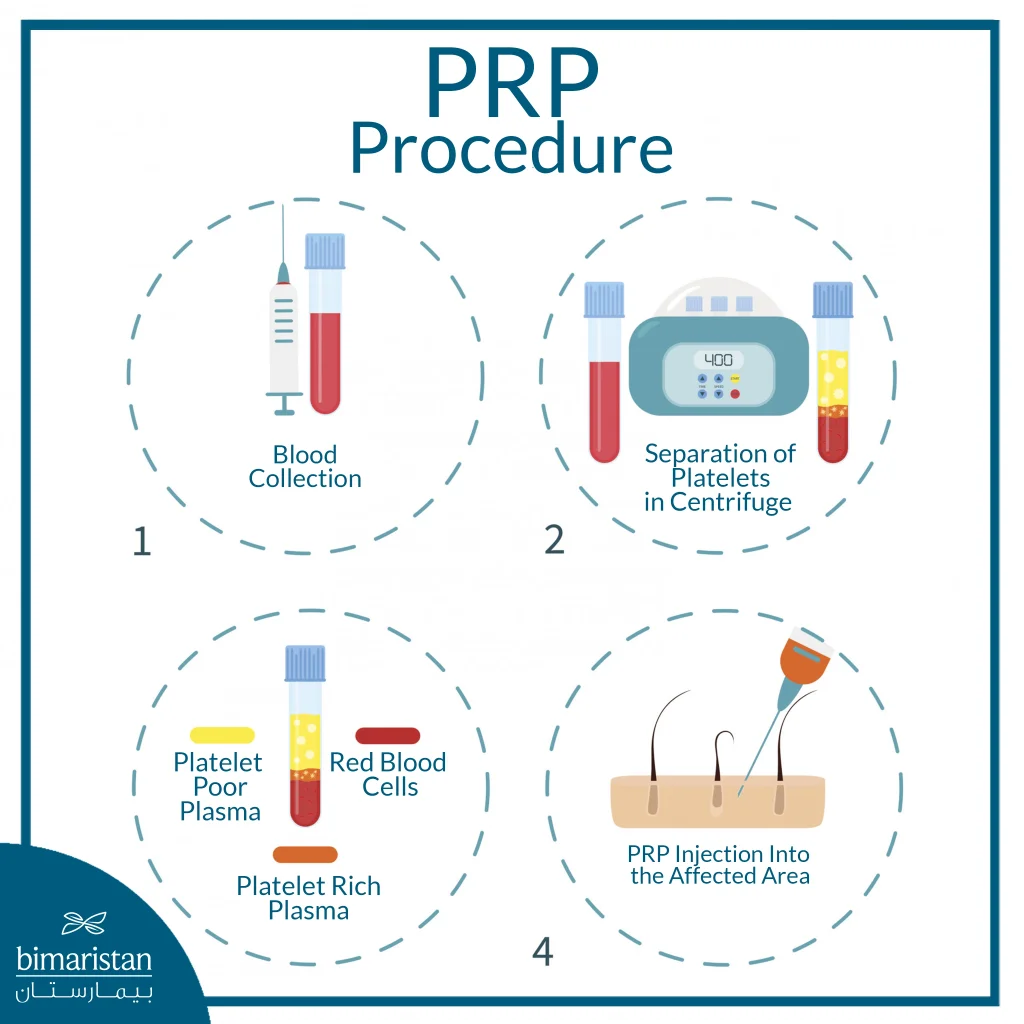 This Image Illustrates The Essential Stages Of Preparing Platelet-Rich Plasma (Prp) Injections