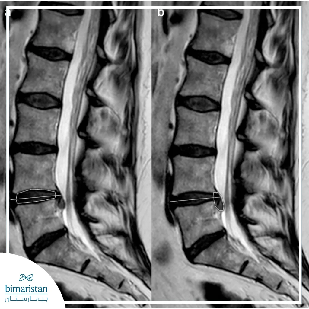 X-Ray Image Showing A Herniated Disc