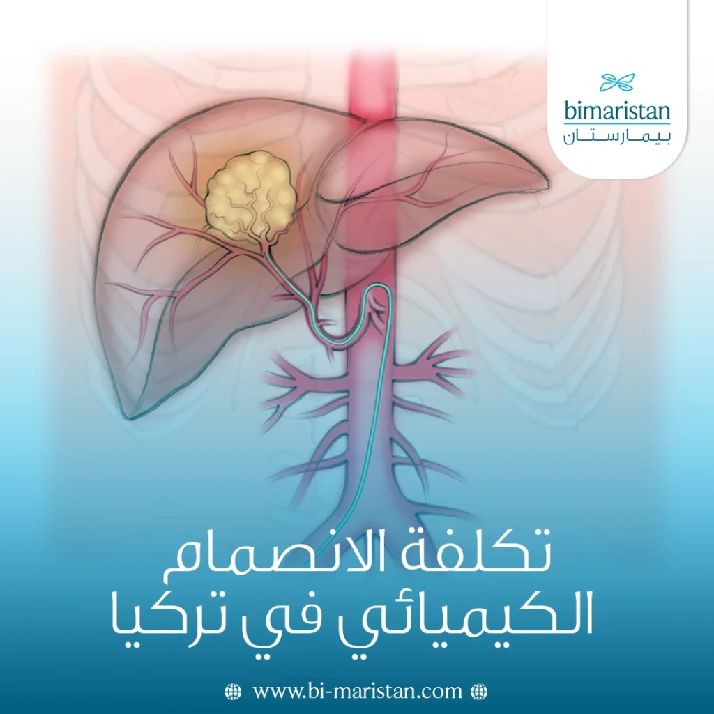 تكلفة الانصمام الكيميائي في تركيا