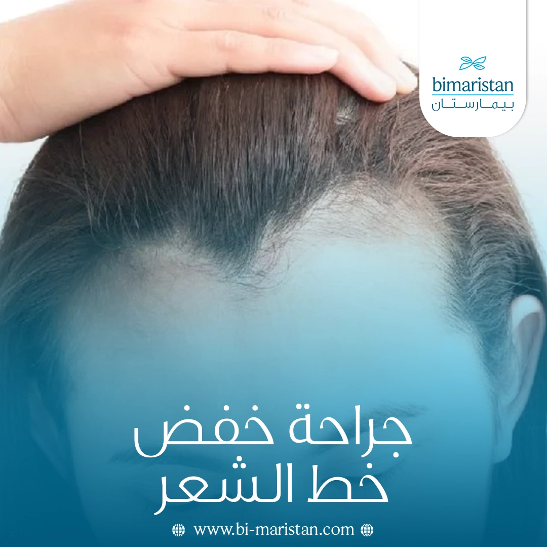 جراحة خفض خط الشعر