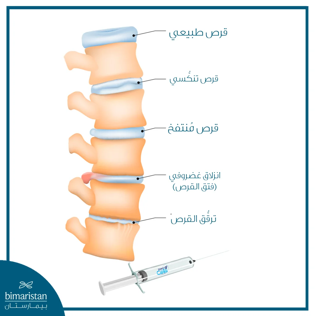 أهم المشاكل الغضروفية التي يمكن حلها بالخلايا الجذعية