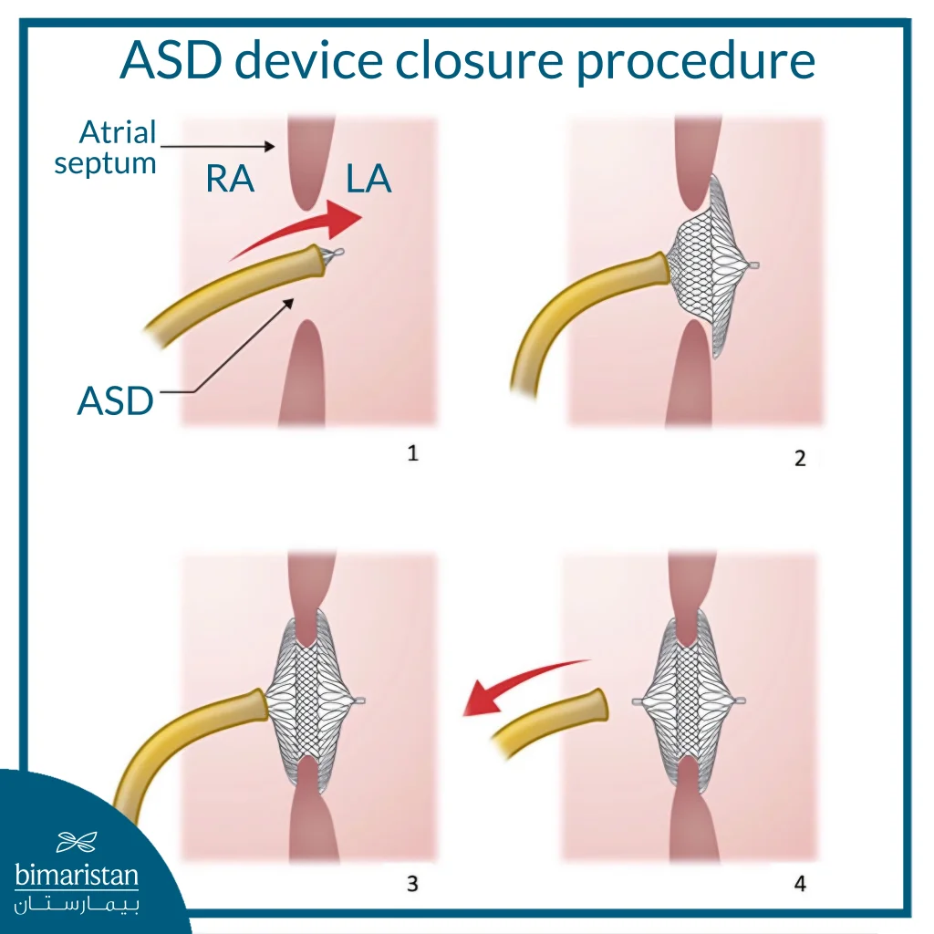 Illustration Showing The Steps Of Atrial Septal Defect (Asd) Closure By Catheter, Where Step 1 Shows Catheter Advancement Through The Right Atrium Toward The Defect, Step 2 Shows Placement Of The Closure Device In The Left Atrium, Step 3 Shows Fixation Of The Device On Both Sides Of The Atrial Septum To Close The Defect, And Step 4 Shows Removal Of The Catheter After Confirming Stable Device Position