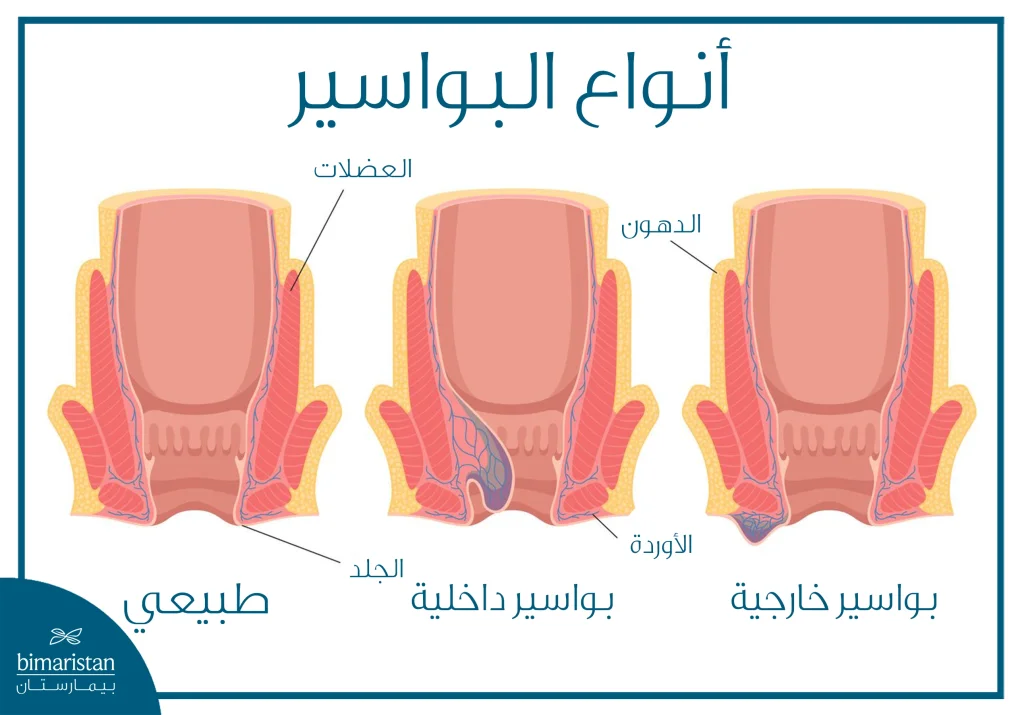 علاج البواسير بالتدبيس: مزايا العملية والتكلفة 4 توضح الصورة أنواع البواسير