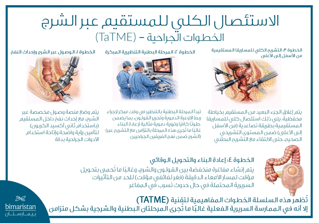 توضح الصورة خطوات عملية الاستئصال الكلي للمستقيم عبر الشرج (Tatme)