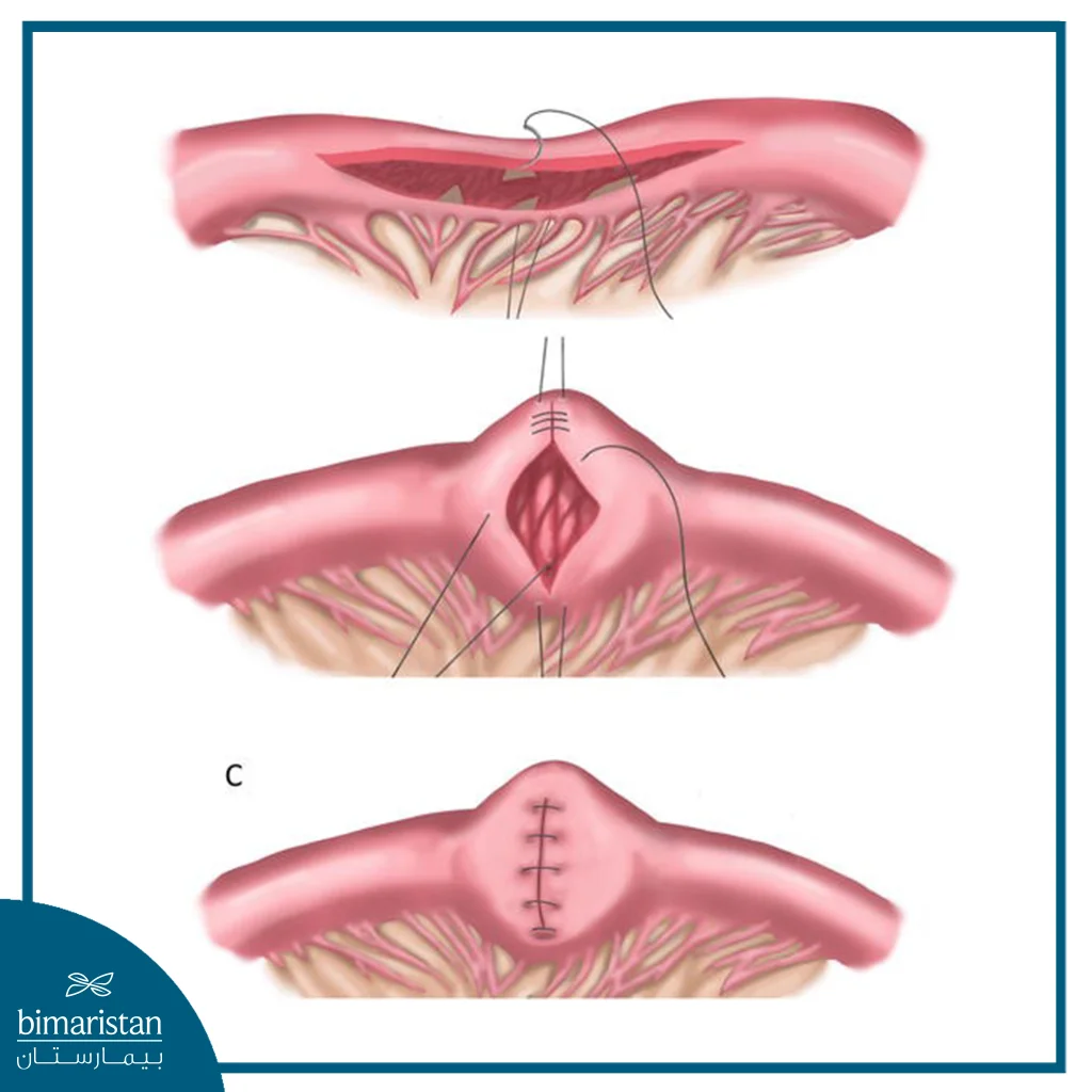 توضح الصورة علاج تضيق الأمعاء الدقيقة الجراحي. عن طريق إجراء شق جراحي طولي من ثم الخياطة بشكل عرضي