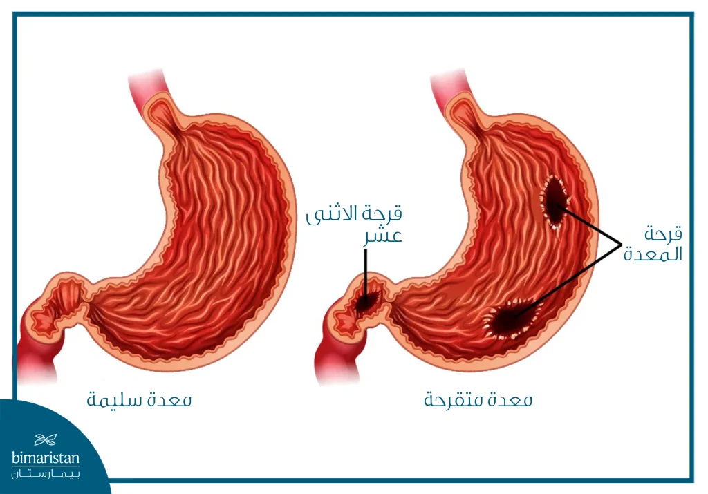 رسم توضيحي يُقارن بين معدة سليمة ومعدة مصابة بالقرحة الهضمية، حيث يُظهر سلامة الغشاء المخاطي في المعدة الطبيعية، مقابل وجود قرحات معدية متعددة وقرحة في الاثني عشر في المعدة المصابة، مع تآكل موضعي في بطانة الجهاز الهضمي نتيجة تأثير الحمض والعوامل الممرِضة.