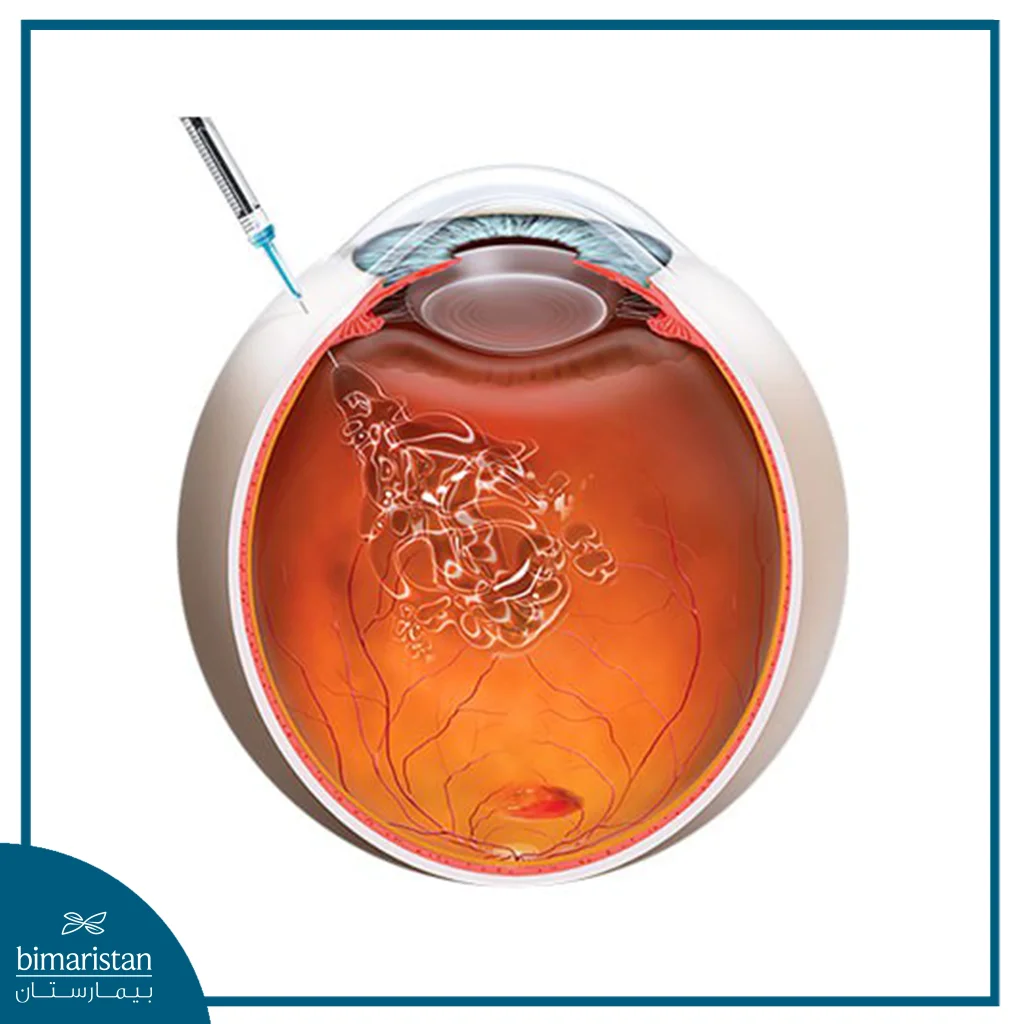 رسم توضيحي توضح حقن داخل الجسم الزجاجي للعين باستخدام إبرة دقيقة.