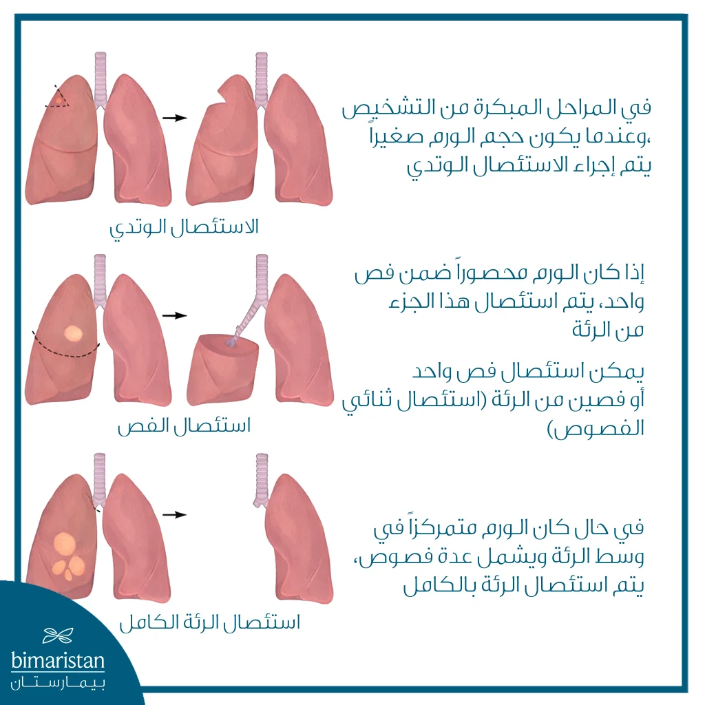 رسم توضيحي يشرح أنواع جراحة سرطان الرئة