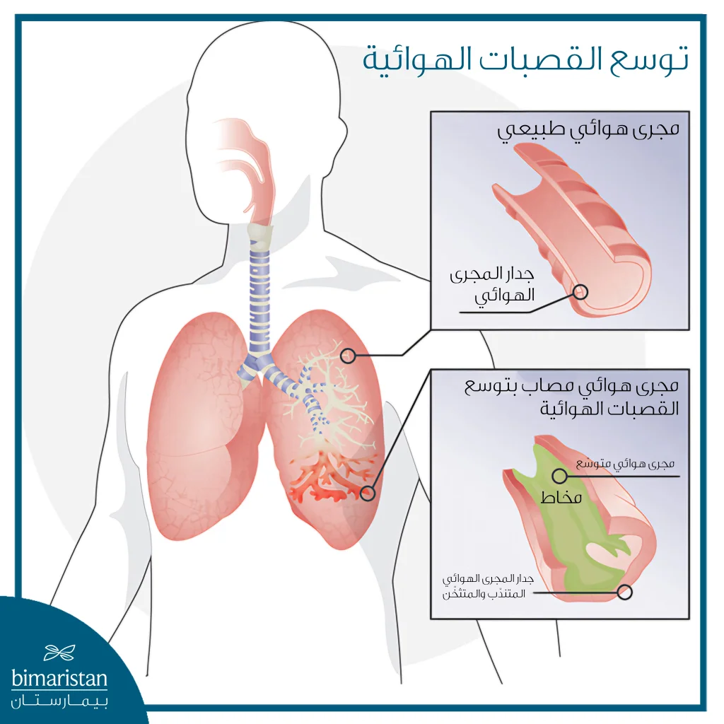 رسم طبي يوضح توسع القصبات الهوائية في الرئتين مع مقارنة بين مجرى هوائي طبيعي ومجرى هوائي متوسّع مع مخاط متراكم