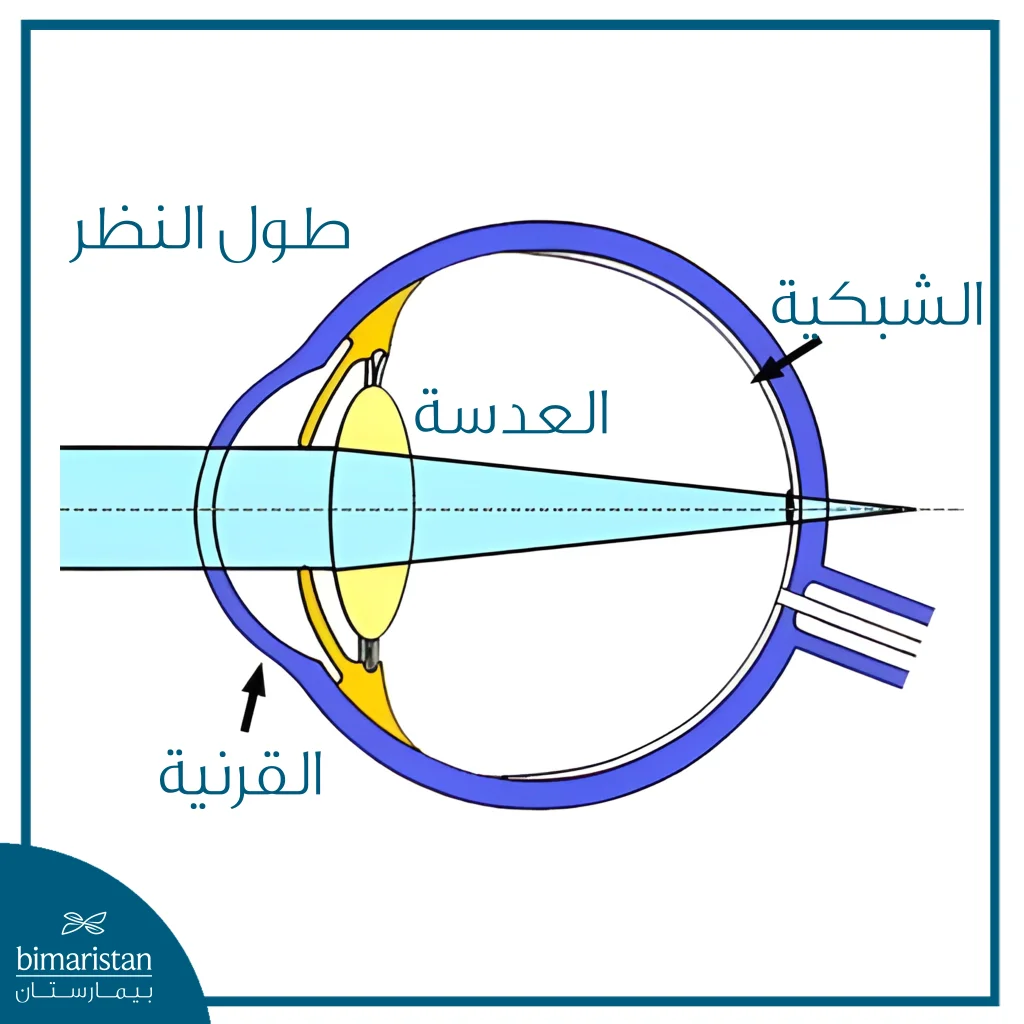 رسم يوضح طول النظر حيث تتركز الأشعة خلف الشبكية.
