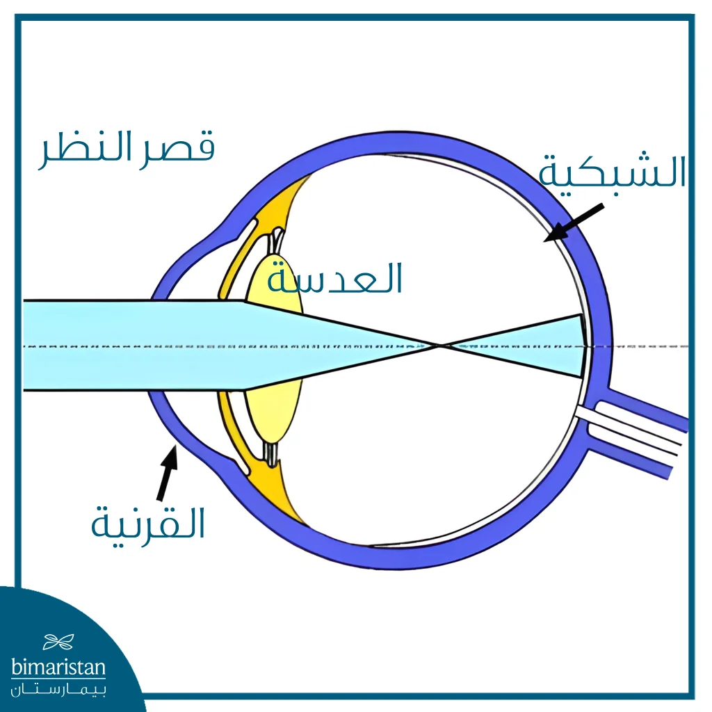 رسم يوضح قصر النظر حيث تتركز الأشعة أمام الشبكية.