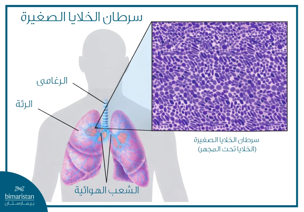 رسم يوضح موقع سرطان الرئة صغير الخلايا في الرئة مع مظهر الخلايا تحت المجهر