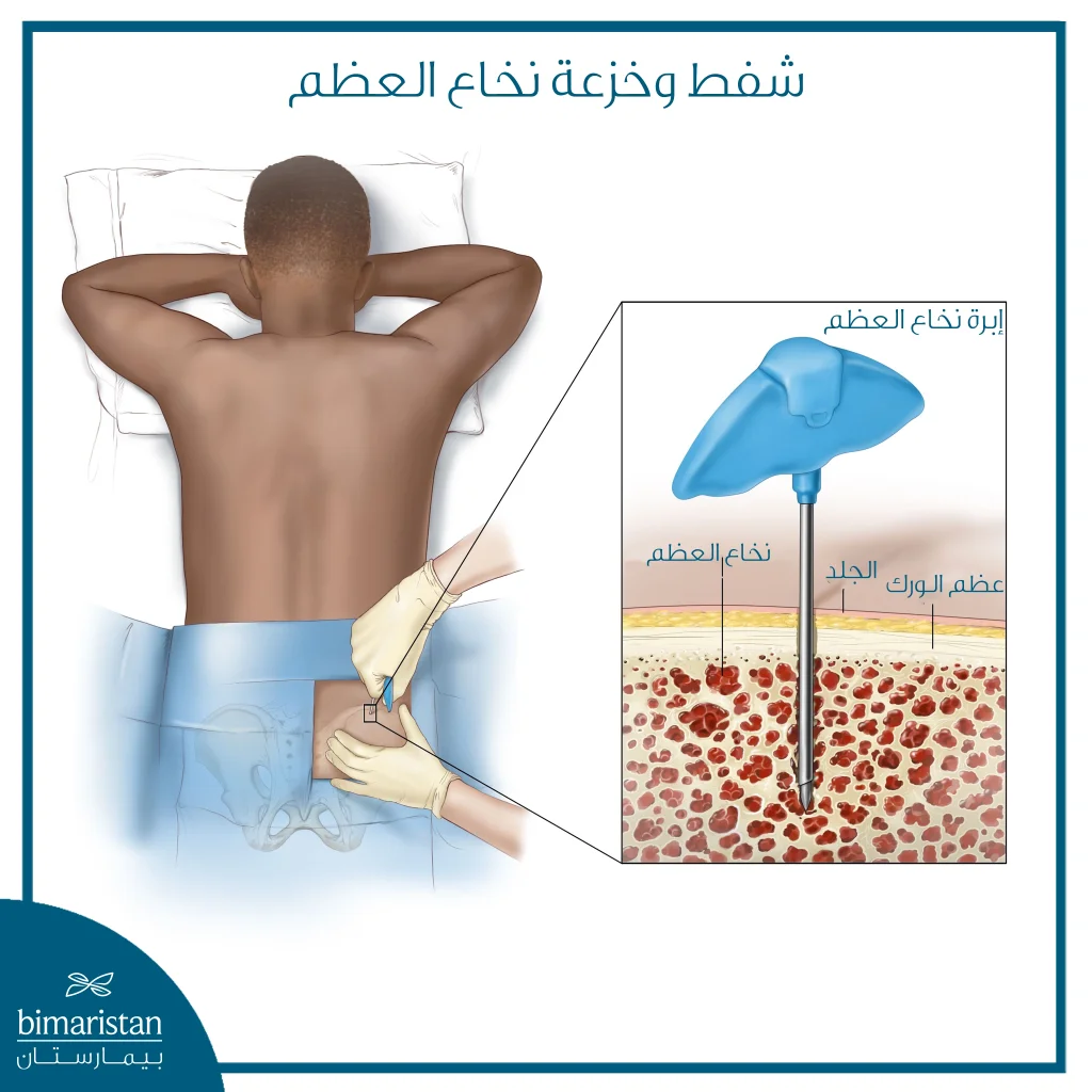 سرطان الدم (اللوكيميا): الدليل الشامل 6 صورة توضح عملية شفط وخزعة نقي العظم لتشخيص اللوكيميا