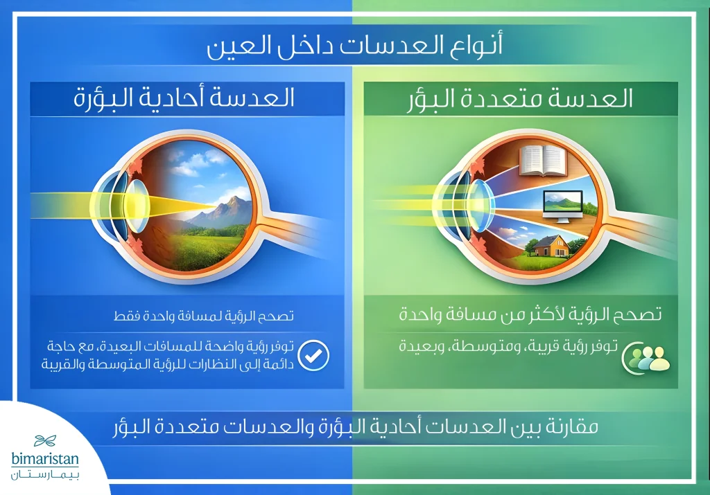 صورة توضيحية تقارن بين العدسة أحادية البؤرة والعدسات متعددة البؤر بعد إزالة المياه البيضاء من حيث تصحيح الرؤية لمسافة واحدة مقابل عدة مسافات.
