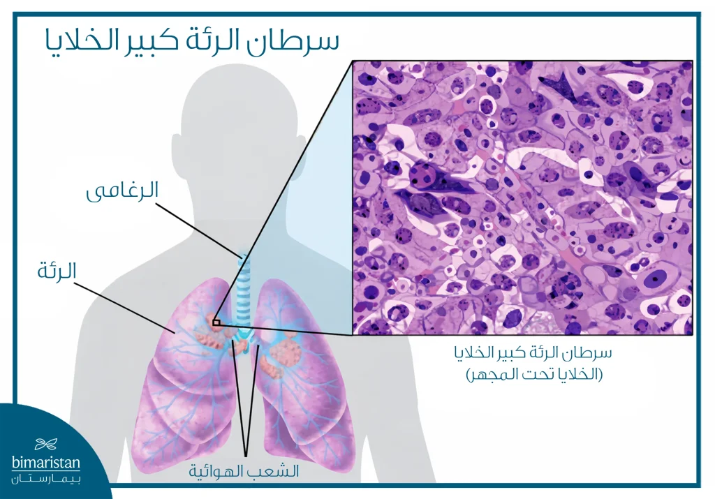 صورة توضيحية تُظهر الرئتين مع تكبير يوضح خلايا سرطان الرئة كبير الخلايا تحت المجهر
