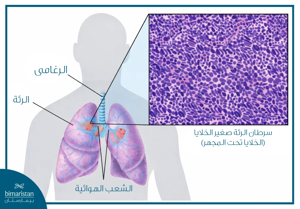 صورة توضيحية للرئتين مع تكبير نسيجي يوضح سرطان الرئة صغير الخلايا تحت المجهر