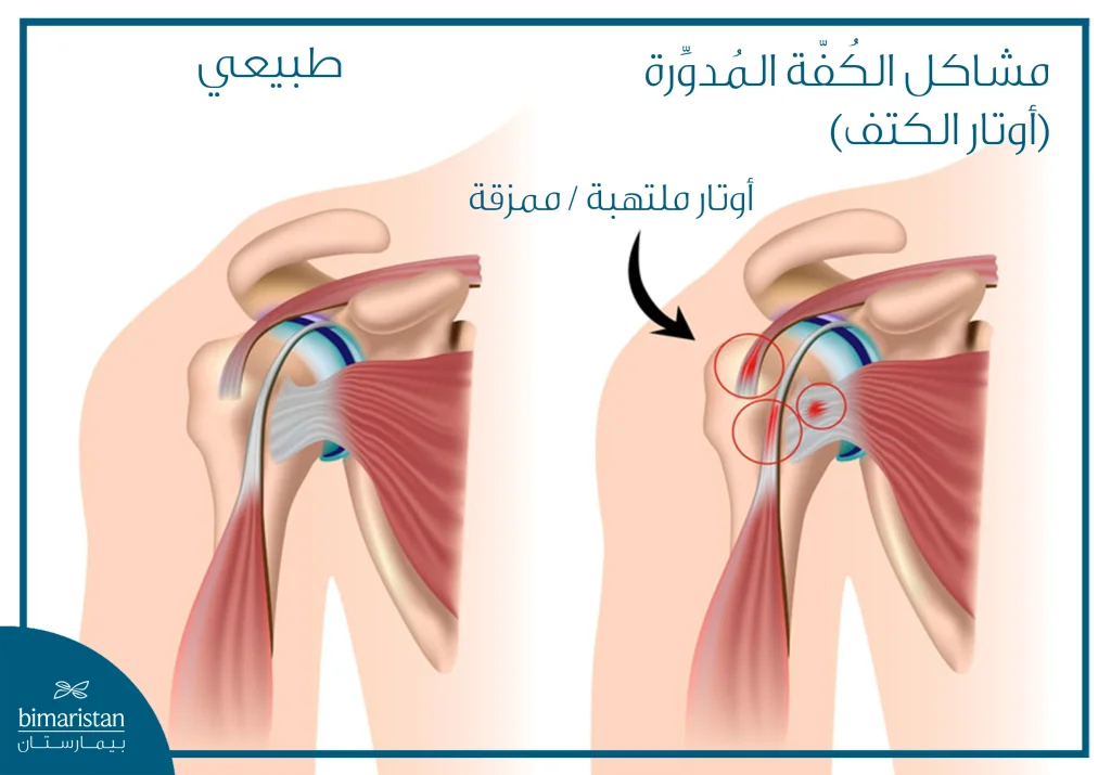 إصلاح أوتار المفاصل: دليل شامل للعلاج والتعافي 6 صورة تُظهر تمزّق أوتار الكتف