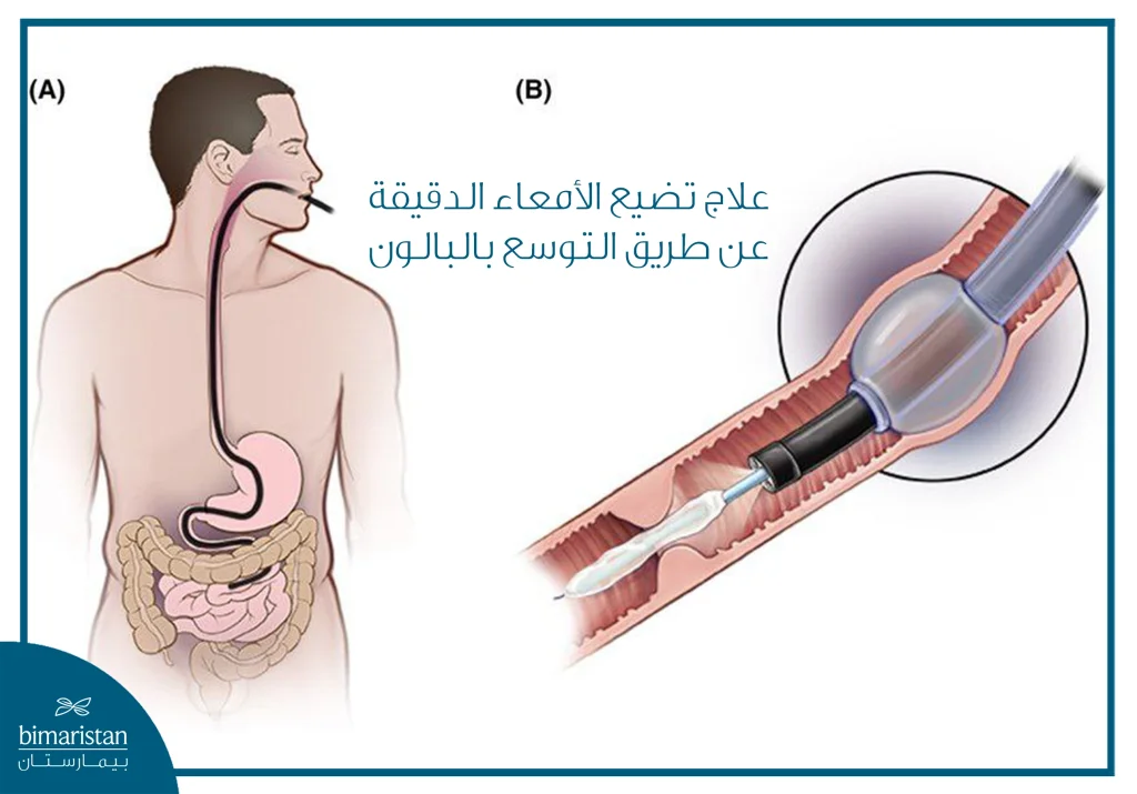 علاج تضيقات الأمعاء الدقيقة عن طريق توسيع الأمعاء الدقيقة بالبالون التنظيري