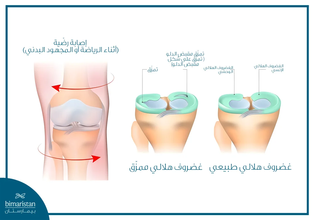كل ما تريد معرفته عن تمزق الغضروف الهلالي