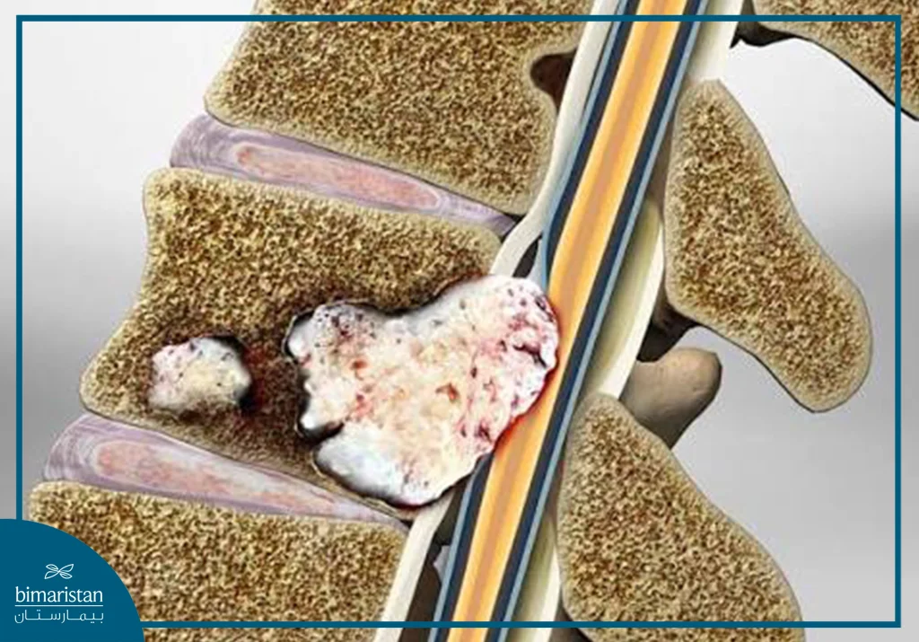 علاج سرطان العمود الفقري بالخلايا الجذعية 13 كل ما تريد معرفته عن سرطان العمود الفقري