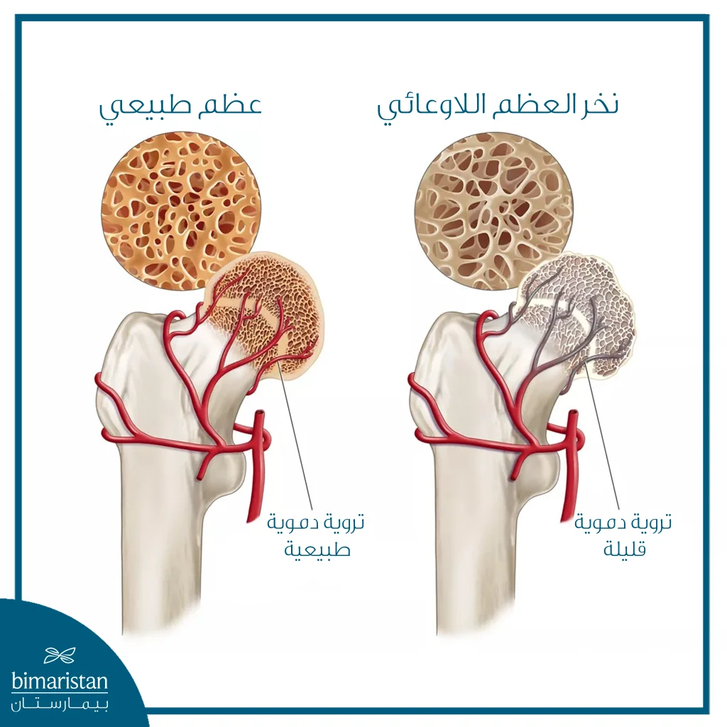 كل ما تريد معرفته عن نخر العظم اللاوعائي