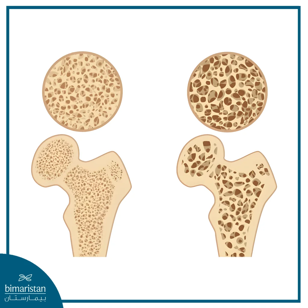 علاج هشاشة العظام بالخلايا الجذعية: الفوائد وطرق العلاج 13 ما هي هشاشة العظام كل ما تريد معرفته