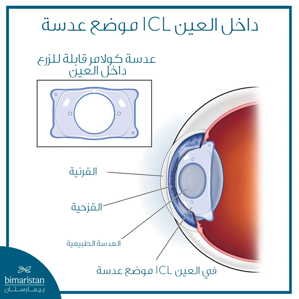 موضع عدسة Icl المزروعة بين القزحية والعدسة الطبيعية داخل العين.