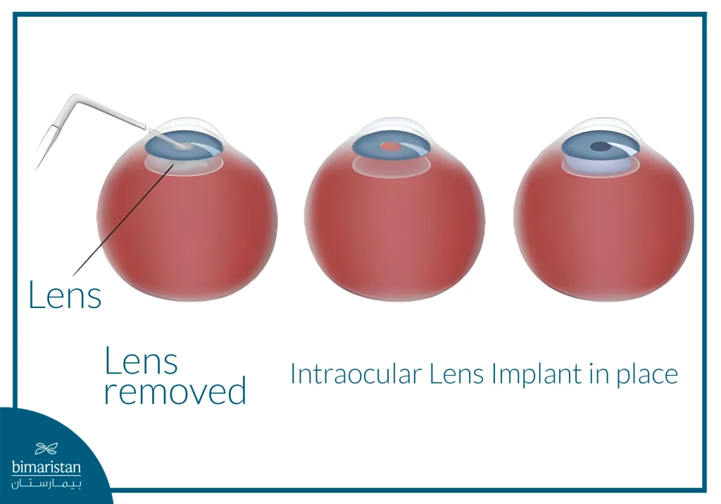 Illustration Showing The Steps Of Intraocular Lens Implantation, Including Insertion Of The Artificial Lens Through A Small Incision And Positioning It Correctly Inside The Eye