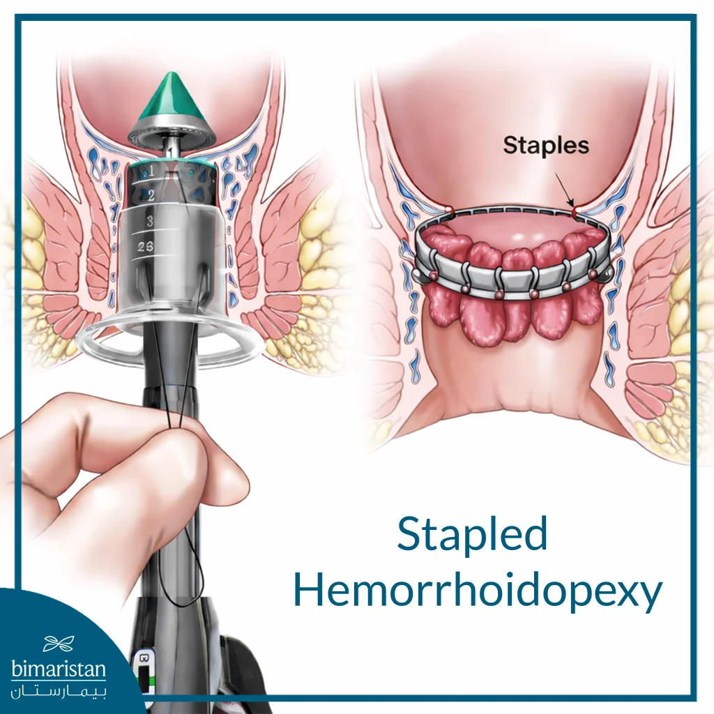 Stapled Hemorrhoidopexy: Benefits, Procedure Details, And Treatment Costs 4 The Image Illustrates The Principle Of Stapled Hemorrhoidopexy, Where The Stapler Removes A Ring Of Rectal Mucosa Above The Dentate Line, While Repositioning The Prolapsed Hemorrhoidal Tissue