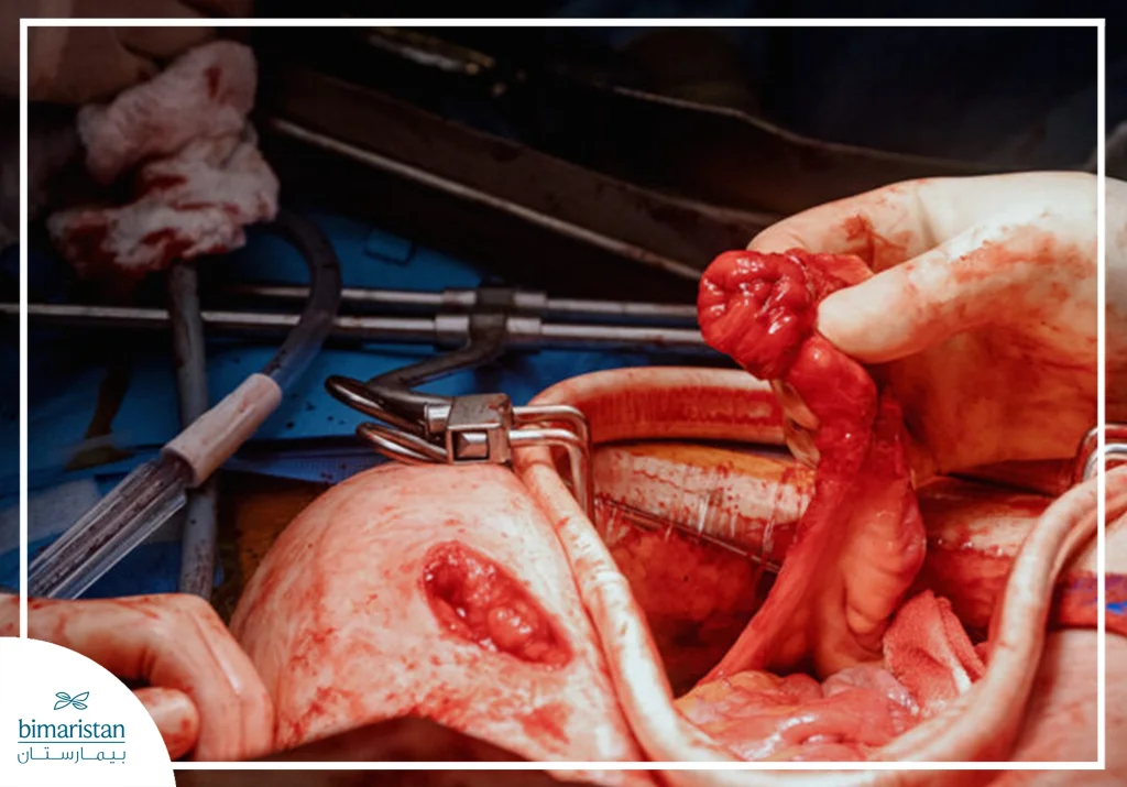 الاستئصال الكلي للمستقيم: لعلاج سرطان المستقيم 5 صورة جراحية أثناء الاستئصال الكلي للمستقيم، تُظهر فصل المستقيم مع المسراق المحيط به ضمن الحيز الحوضي، بما يتوافق مع مبادئ الاستئصال الكلي لمسراق المستقيم (Tme)، بهدف إزالة الورم مع العقد اللمفاوية المحيطة وتقليل خطر النكس الموضعي.