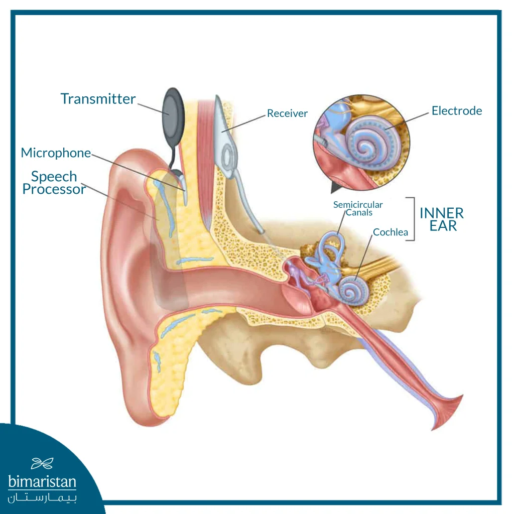 The Image Illustrates A Cochlear Implant Inside The Ear, And How Sound Signals Are Transmitted From The External Device To The Cochlea To Stimulate The Auditory Nerve And Improve Hearing.