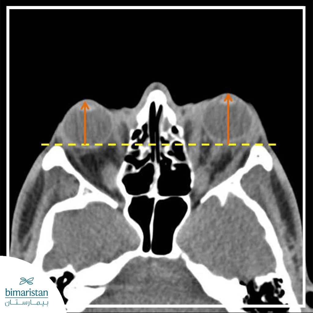 An Axial Ct Scan Of The Orbits Demonstrating Bilateral Proptosis, With Reference Measurement Lines Used To Assess The Degree Of Eye Protrusion Prior To Orbital Decompression Surgery.