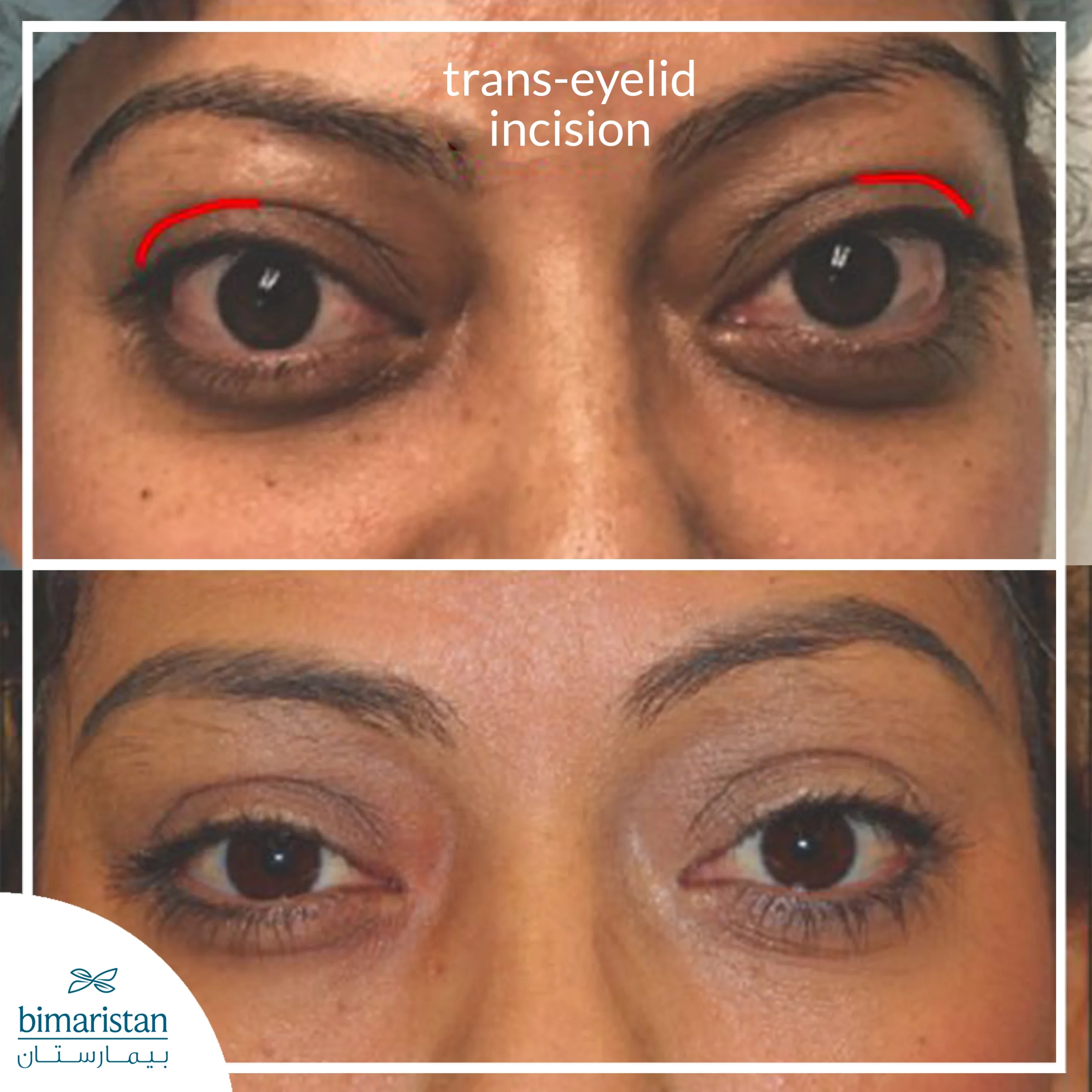 Clinical Before-And-After Photographs Of Orbital Decompression Performed Via A Trans-Eyelid Incision, Demonstrating Improvement In Eye Protrusion And Restoration Of A More Normal Globe Position.