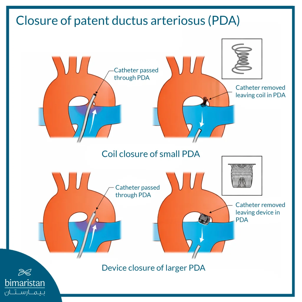 An Illustration Explaining The Closure Of A Patent Ductus Arteriosus (Pda) Using A Catheter. The Catheter Is Inserted Through The Duct And Then Closed Either With A Metal Coil In Small Cases Or With A Special Closure Device In Larger Ducts, With The Position Of The Device Shown After Catheter Removal.