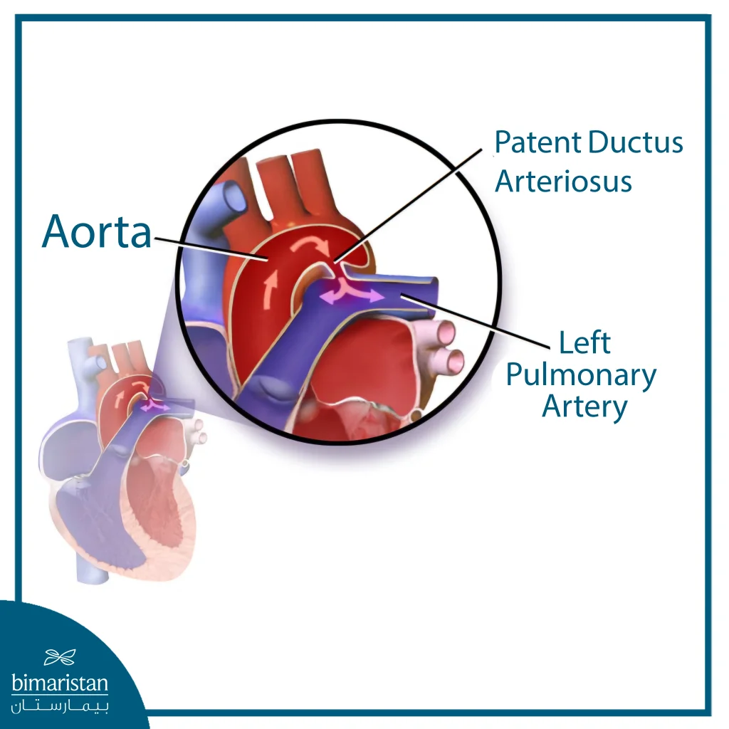An Anatomical Illustration Showing Patent Ductus Arteriosus (Pda) And Abnormal Blood Flow Between The Aorta And The Left Pulmonary Artery, Highlighting The Location Of The Ductus And Its Effect On Cardiac Circulation