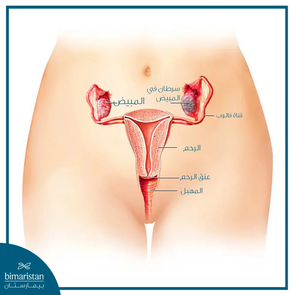 استئصال البوق والمبيض الثنائي: الدواعي والخطوات والمضاعفات 3 رسم تشريحي يوضّح الجهاز التناسلي الأنثوي مع إظهار موضع سرطان المبيض، حيث تظهر المبايض، قناتا فالوب، الرحم، عنق الرحم، والمهبل، مع تمييز الورم في أحد المبيضين.