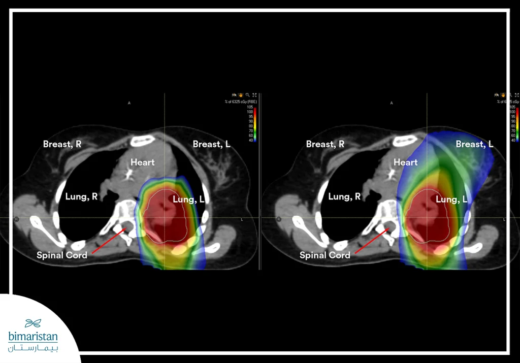 Image Showing Radiation Dose Distribution In Lung Cancer Treatment; The Left Side Illustrates Proton Therapy With Radiation Concentrated In The Tumor And Less Exposure To Surrounding Healthy Tissue, While The Right Side Shows Conventional X-Ray Radiation Therapy With Radiation Spreading To A Larger Area Of Healthy Tissues, Such As The Lung And Heart