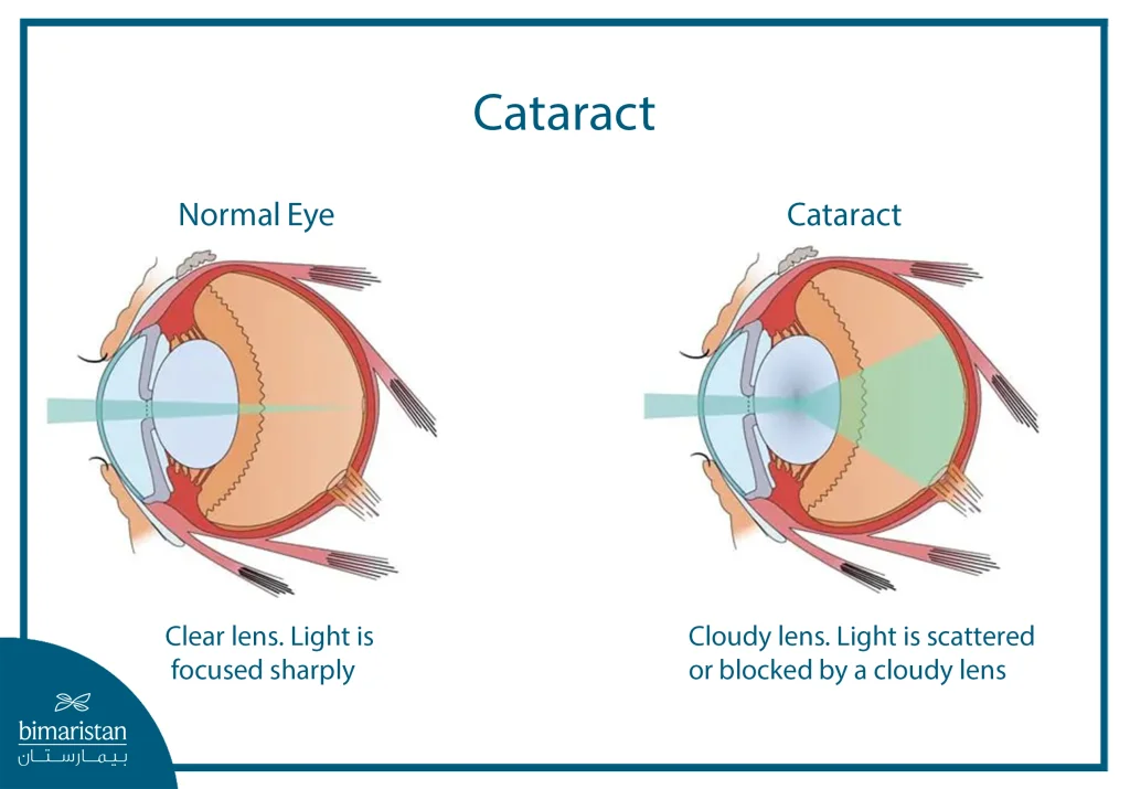 Toric Lens: The Precise Solution For Correcting Astigmatism During Cataract Surgery 4 An Anatomical Illustration Comparing A Normal Eye With A Cataract-Affected Eye, Showing How A Clear Lens Focuses Light Sharply Versus A Cloudy Lens That Scatters Light And Reduces Vision Quality.