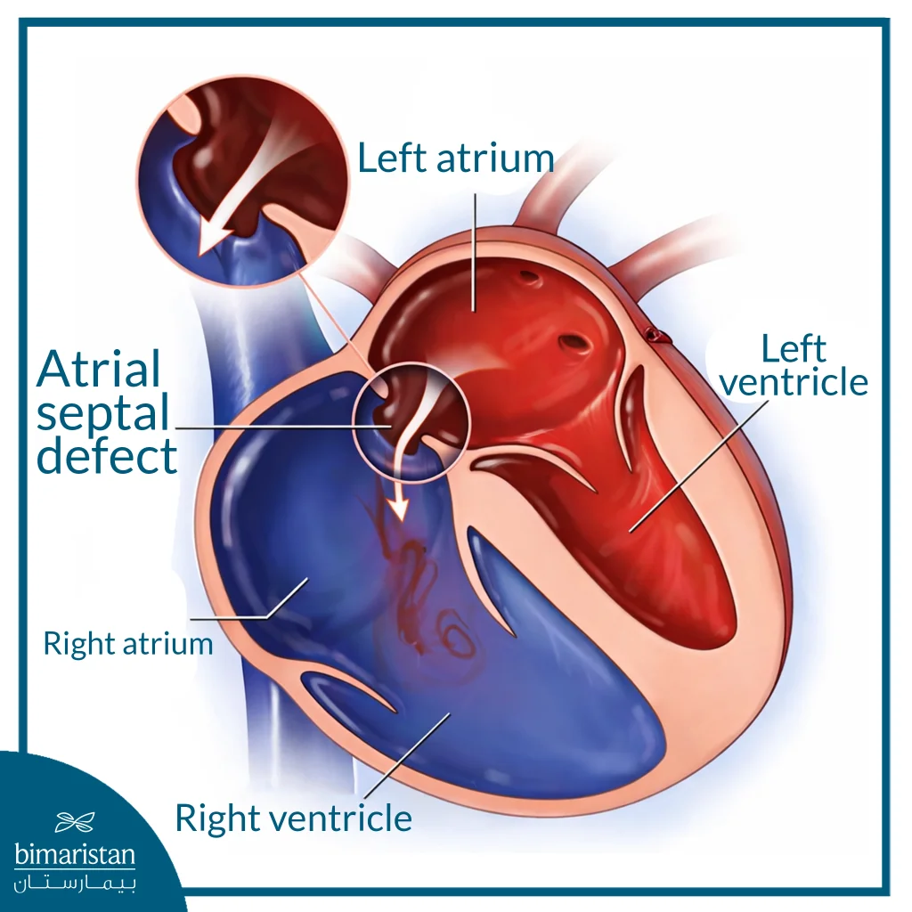 Illustration Of The Heart Showing An Atrial Septal Defect, With An Abnormal Opening Between The Left And Right Atria Allowing Blood To Flow From The Left Side To The Right Side Of The Heart
