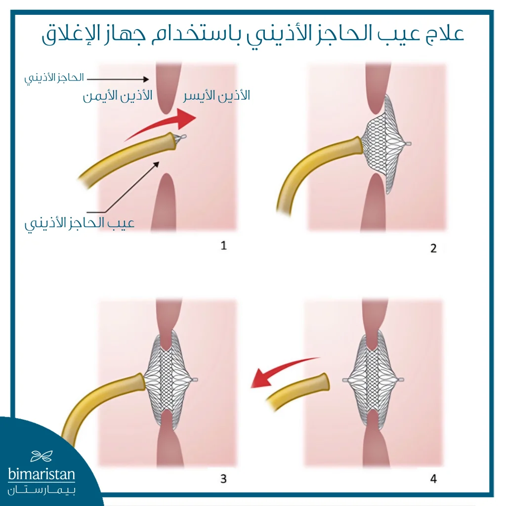 رسم توضيحي يبيّن خطوات إغلاق عيب الحاجز الأذيني بالقسطرة، حيث يُظهر الرقم 1 إدخال القسطرة عبر الأذين الأيمن نحو الفتحة، الرقم 2 وضع جهاز الإغلاق داخل الأذين الأيسر، الرقم 3 تثبيت الجهاز على جانبي الحاجز الأذيني لإغلاق العيب، والرقم 4 سحب القسطرة بعد التأكد من ثبات جهاز الإغلاقرسم توضيحي يبيّن خطوات إغلاق عيب الحاجز الأذيني بالقسطرة، حيث يُظهر الرقم 1 إدخال القسطرة عبر الأذين الأيمن نحو الفتحة، الرقم 2 وضع جهاز الإغلاق داخل الأذين الأيسر، الرقم 3 تثبيت الجهاز على جانبي الحاجز الأذيني لإغلاق العيب، والرقم 4 سحب القسطرة بعد التأكد من ثبات جهاز الإغلاق