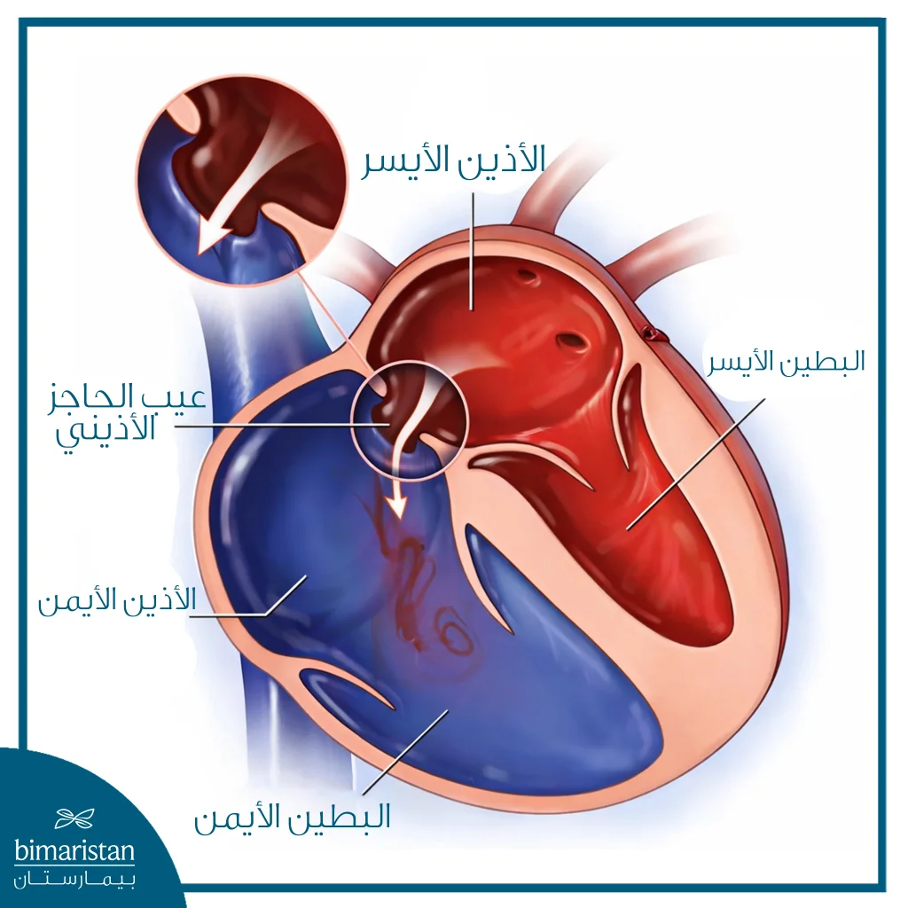 رسم توضيحي للقلب يبيّن عيب الحاجز الأذيني، مع وجود فتحة بين الأذين الأيسر والأذين الأيمن تسمح بانتقال الدم من الجهة اليسرى إلى الجهة اليمنى من القلب