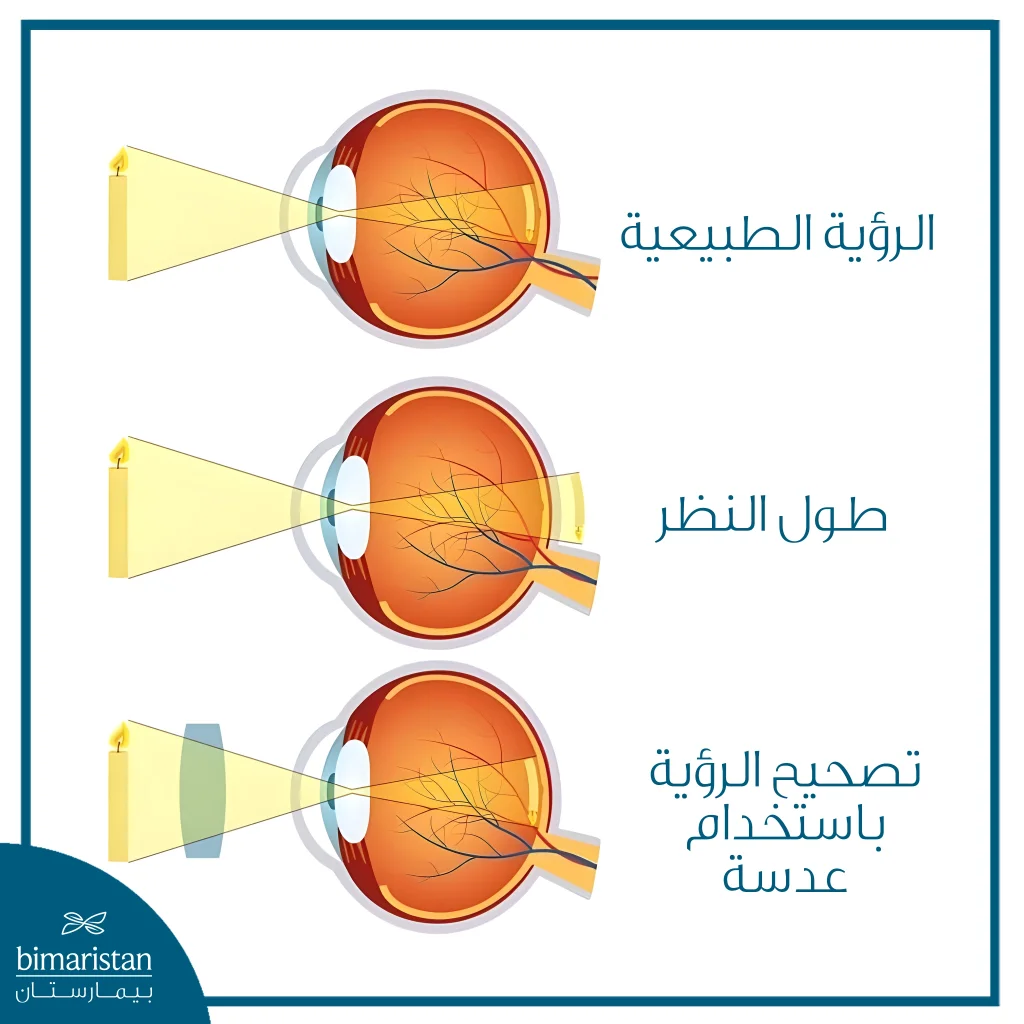 رسم تشريحي يوضح الفرق بين الرؤية الطبيعية وطول النظر، حيث تتكوّن الصورة خلف الشبكية في طول النظر، مع توضيح كيفية تصحيح هذا الخلل باستخدام عدسة تعمل على إعادة تركيز الضوء على الشبكية.