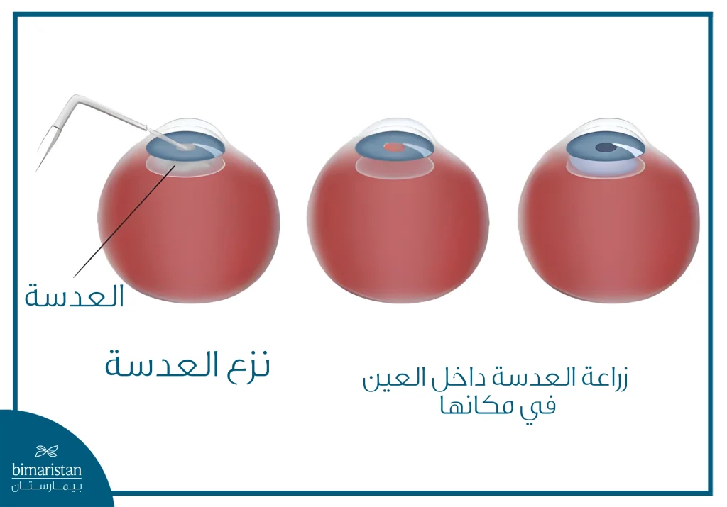 رسم توضيحي يبيّن خطوات زراعة العدسة داخل العين، حيث تظهر عملية إدخال العدسة الصناعية عبر شق صغير في العين ثم تثبيتها في موضعها الصحيح أمام أو خلف العدسة الطبيعية.